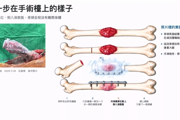 骨癌患者治療免截骨 北榮研發重建技術已完成200例
